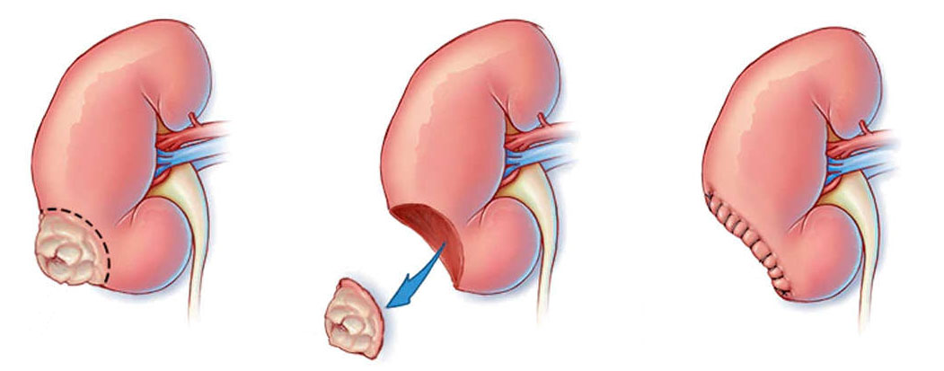 Esquema de la nefrectomia parcial: extirpació del tumor i reconstrucció del ronyó